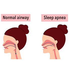 Diagram comparing healthy airway vs. obstructive sleep apnea